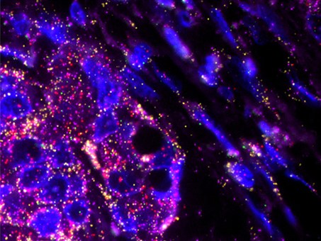 The RNAscope Multiplex Assay from Advanced Cell Diagnostics can help researchers generate fluorescence images such as this, of human breast cancer tissue.