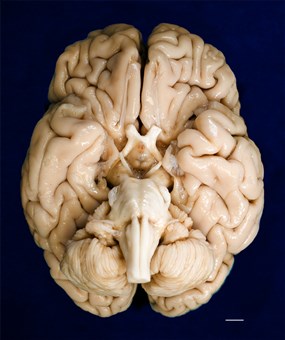 The ventral surface of H.M's brain taken before the cryopreservation process
