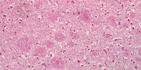 image: Restless Nights Predict Alzheimer’s?