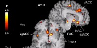image: Personality Predicts Placebo Effect