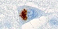 image: Non-coding Repeats Cause Peptide Clumps