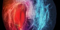 image: Image of the Day: Cerebral Infiltration