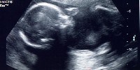 image: New DNA-based Prenatal Test