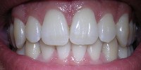 image: Teasing Out New Teeth