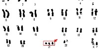 image: New Down Syndrome Protein Found