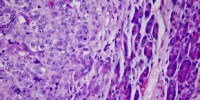 image: Exploring the Tumor Neighborhood