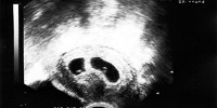 image: Leukemia Linked to Changes in Womb
