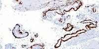image: Cancer Drug for Alzheimer’s Disappoints