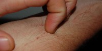 image: Distinct Neural Pathway for Itchiness
