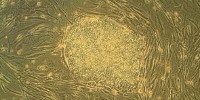 image: Stroke Patients Improve with Stem Cells