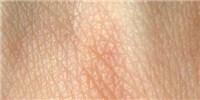 image: Odor-like Biomarkers for Skin Cancer