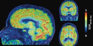 Gene Expression Imaged in the Living Human Brain