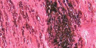 Rare T Cells Fight Cancer