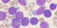 image: Thwarting leukemia drug resistance