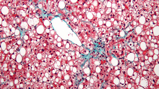 Stem cells may mend liver damage image: Stem cells may mend liver damage