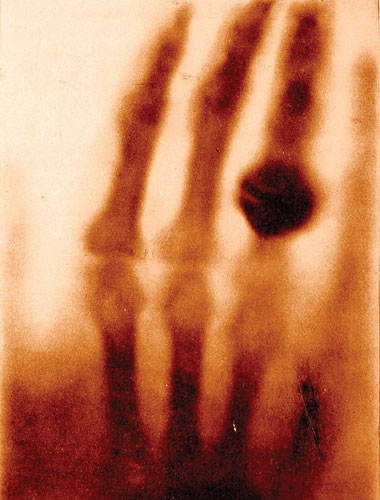 The First X-ray, 1895 image: The First X-ray, 1895