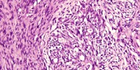 image: Drugs target cancer stem cells