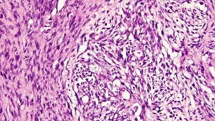 Drugs target cancer stem cells image: Drugs target cancer stem cells