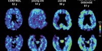 image: Down Syndrome brains look like Alzheimer’s