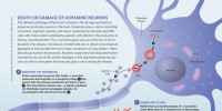 image: Death or Damage of Dopamine Neurons