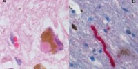 image: New insights into Parkinson’s Disease
