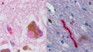 New insights into Parkinson’s Disease image: New insights into Parkinson’s Disease