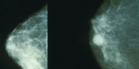 image: Prostate Drug for Breast Cancer?