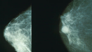 Prostate Drug for Breast Cancer? image: Prostate Drug for Breast Cancer?