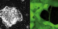 image: Ovarian cancer forces into new tissues