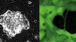 Ovarian cancer forces into new tissues image: Ovarian cancer forces into new tissues