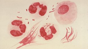 Gonorrhea Threat image: Gonorrhea Threat