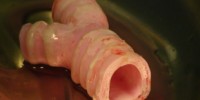 image: Synthetic Organ Transplant Success