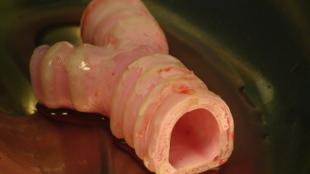 Synthetic Organ Transplant Success image: Synthetic Organ Transplant Success
