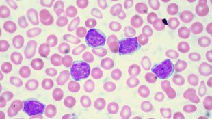 Turning T-cells into Cancer Killers image: Turning T-cells into Cancer Killers