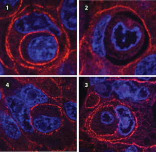 Entosis in Human Breast Tumors: Cells undergoing entosis illustrate some of the possible fates of internalized cells. The red stain highlights beta-catenin, a cell-cell adhesion protein found along the cells’ perimeters, and the blue labels the nuclei of both the host and internalized cells. 1. Cell within a another cell, squishing the host cell nucleus into a crescent shape. 2. An internalized cell undergoing cell death. 3. An internalized cell undergoing cell division. 4. A 3-cell structure—a cell within another cell, within a another cell.