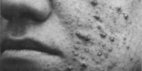 image: Acne Treatments Lack Science