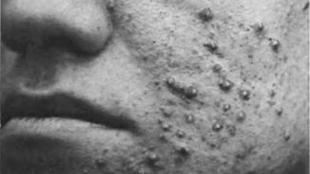 Acne Treatments Lack Science image: Acne Treatments Lack Science