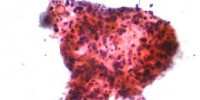 image: Shielding Cancer Cells from Damage