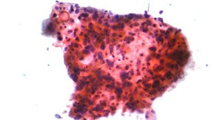 Shielding Cancer Cells from Damage image: Shielding Cancer Cells from Damage