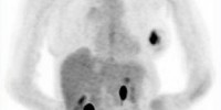 image: Genentech Plans New Avastin Trial