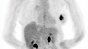 Genentech Plans New Avastin Trial image: Genentech Plans New Avastin Trial