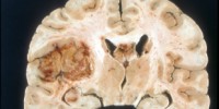 image: Neurosurgery Resident Plagiarized Research