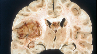 Neurosurgery Resident Plagiarized Research image: Neurosurgery Resident Plagiarized Research