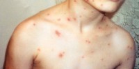 image: Sun Prevents Chickenpox?