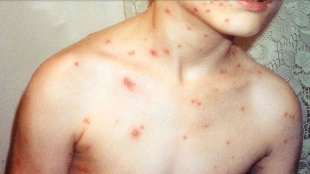 Sun Prevents Chickenpox? image: Sun Prevents Chickenpox?