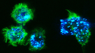Skin Cells Cause Cancer? image: Skin Cells Cause Cancer?