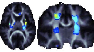 Brain scans showing that a genetic variant that promotes higher brain integrity in the areas highlighted in blue and yellow