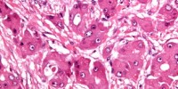 image: Electromagnetic Fields Shrink Tumors