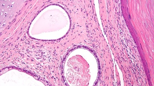 Teratomas with three differentiated layers from stem cells visible.