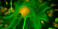 Research assistant at MD Anderson Cancer Center, Geoffrey Grandjean, obtained this image showing human ovarian cancer cells stained for DNA (red) and microtubules (green), during an siRNA screening. The particular gene knockdown in this screen disrupted cell division, causing the giant cell in the middle to grow very large. 2011 IN Cell Analyzer Image Competition